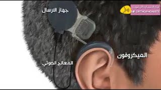 الجهاز القوقعي و طريقة عمله داخل الأذن  implant cochléaire [upl. by Patrice939]