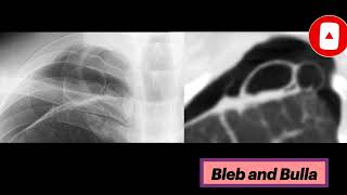 Blebs and Bullae radiology thoracicsurgery pulmonology [upl. by Derian]