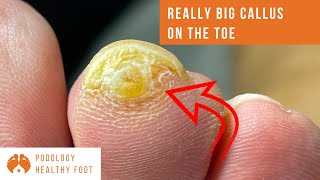 REALLY BIG CALLUS ON THE TOE  Removal  PodiatryMetatarsalPodiatristPodologiaFeetASMR podiatry [upl. by Elyssa]