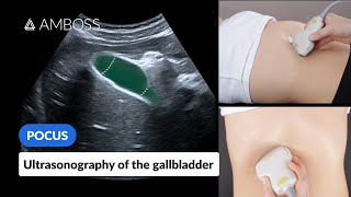 Point of Care Ultrasound of the Gallbladder  AMBOSS Video [upl. by Nolahs680]