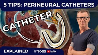 5 TIPS PERINEURAL CATHETERS  Crash course with Dr Hadzic [upl. by Eynahpets]