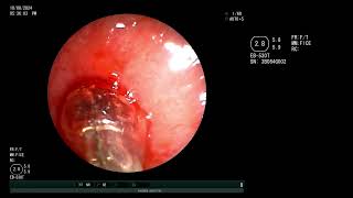 Emergent Central airway obstruction Subglottic stenosis  Dilatation and silicone stent placement [upl. by Kannan]