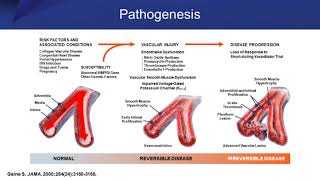 Pulmonary Arterial Hypertension Addressing Diagnostic and Therapeutic Challenges [upl. by Dnomyad]