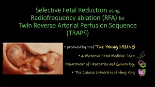 TRAPS twin reduced by Radiofrequency ablation [upl. by Mandel4]