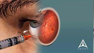 How Macular Degeneration Affects Your Vision  3D animation [upl. by Cohla630]