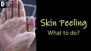 What causes skin peeling from fingers and feet How to manage  Dr Rasya Dixit [upl. by Cherianne]