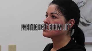 PDO Perfecto Threads  Eyebrow Lift  Eterna MD Medical Rejuvenation Center  Orlando FL [upl. by Booker862]