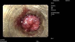 Bleeding Grade III Internal Haemorrhoids seen on Video Proctoscopy [upl. by Barrington292]