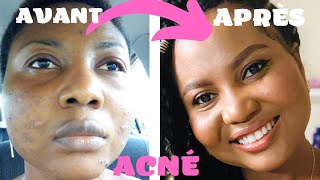 ACNÉ  Comment en FINIR DÉFINITIVEMENT  Une Crème pharmaceutique MIRACLE 🔥 SKINCARE [upl. by Pollyanna]