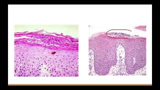 Psoriasis Clinical picture Histopathology [upl. by Mistrot225]