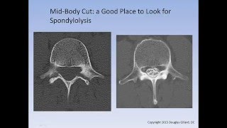 The Spondylolysis  Spondylolisthesis Lecture [upl. by Nodnal]