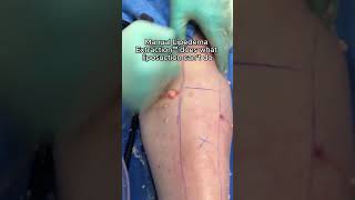 Manual Lipedema Extraction™ [upl. by Siriso]