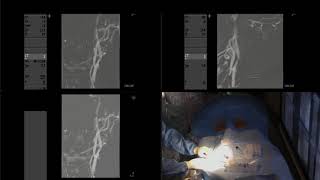 Balloon angioplasty and stenting of severe carotid stenosis [upl. by Akkinahs57]