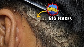 Psoriasis Scalp Scratching Big Flakes Dandruff Removal Satisfying 322 [upl. by Aniroz644]