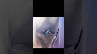 Anterior cruciate ligament injuryknee ligament injuryanimation trending shortvideo shorts [upl. by Sixel]