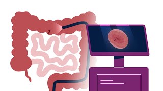 What is a Colonoscopy [upl. by Eyaf]