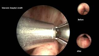 Urolift 2 implant case [upl. by Cati962]