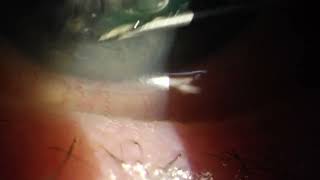 Eye Needle for Recurrent Corneal Erosion RCE [upl. by Aix187]