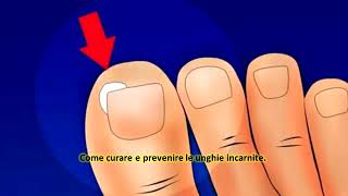 Come curare e prevenire le unghie incarnite [upl. by Eelsnia288]