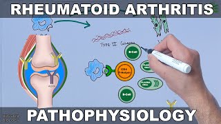 Rhematoid Arrhritis  Pathophysiology Mechanism [upl. by Atyekram486]