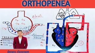 Orthopnea  machanism of orthopnea in hindi [upl. by Norreg]