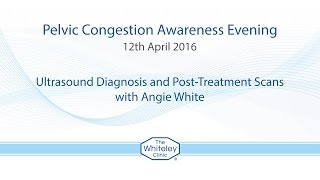 Angie White  Ultrasound Diagnosis and PostTreatment Scans  Pelvic Congestion Awareness Evening [upl. by Lessard]