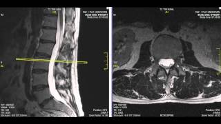 Normal Lumbar Spine MRI Explained  Dr Jeffrey P Johnson  HD [upl. by Lairea]