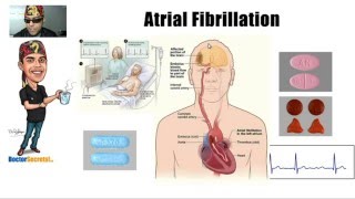 What is Atrial Fibrillation afib Symptoms and Treatment of afib Explained Simply [upl. by Charleton]