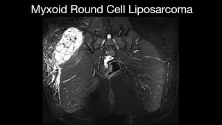 Myxoid Round Cell Liposarcoma [upl. by Relda416]