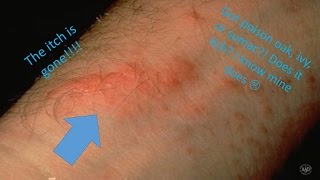 How to make your Poison Oak Ivy or Sumac rash stop itching [upl. by Ovatsug]