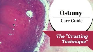 The Ostomy Crusting Technique Explained [upl. by Massimiliano]