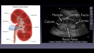 Introduction to Renal Ultrasound [upl. by Aisenat]