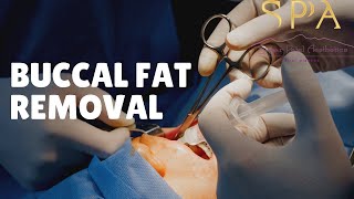 Buccal Fat Removal Basics Cost Technique Facts and Myths [upl. by Lucienne]