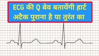 q wave abnormalities  pathological Q wave  q wave ecg [upl. by Reisinger809]