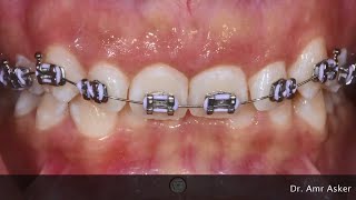 UNILATERAL DISTALIZATION  ORTHODONTIC TIPS Shorts [upl. by Eyanaj]