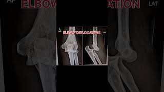 Elbow dislocation x ray [upl. by Neemsaj]