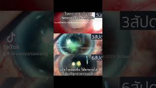 neurotrophic keratitis [upl. by Ammej]