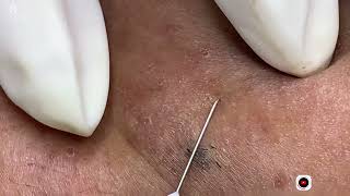 Big Cystic Acne Blackheads Extraction Blackheads amp Milia Whiteheads Removal Pimple Popping [upl. by Heyes504]