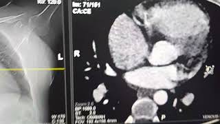 Cardiac CT in different cutting levels [upl. by Menell]