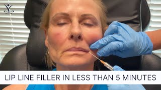 Filler for Lip Lines Using a Cannula [upl. by Maxim]