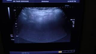 RT PYONEPHROSIS with U BLADDER MASS [upl. by Haskell]