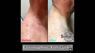 Eosinophilic Folliculitis [upl. by Binnings155]