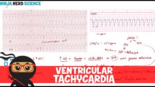 Rate and Rhythm  Ventricular Tachycardia [upl. by Farny562]