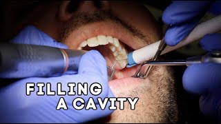 How Does A Dentist Fill A Cavity [upl. by Hnahk603]