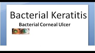 Ophthalmology 111 a Bacterial Keratitis Corneal Ulcer Cornea Bacteria Infective Hypopyon infection [upl. by Garate]