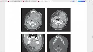 NEURORADIOLOGY EXAM CASES LECTURE [upl. by Cock]