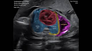 Lymphangiome macrokystique thoracoaxillaire gauche  Foetus de 26 SA [upl. by Arenahs]