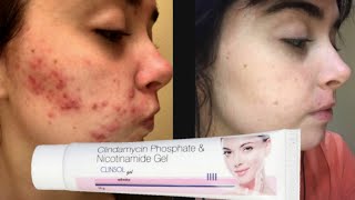 Clinsol Gel Remove pimples Acne Acne scarsblackheadspigmentation from face in just 7 days [upl. by Lanam]