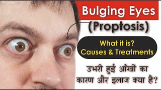 What is Bulging Eyes Proptosis Causes amp Treatments  उभरी हुई आंखों का असल कारण क्या है [upl. by Tirrag]