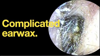 Complicated earwax ear wax removal  ear cleaning  ASMR  relaxation  relax [upl. by Sonya198]